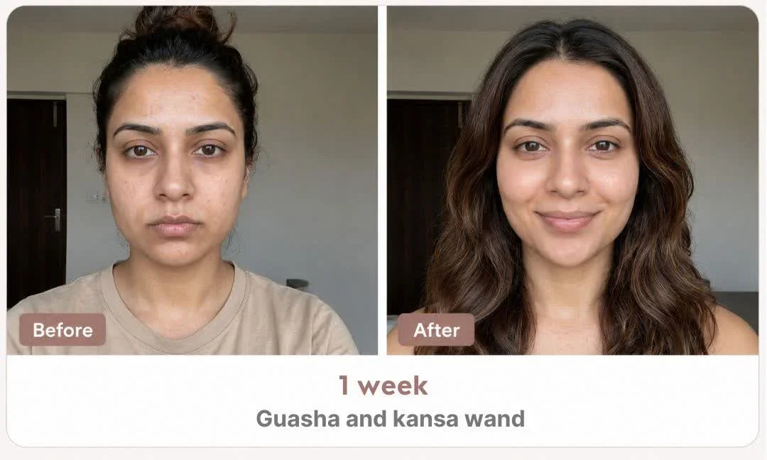 Before and after — Hormonal Acne results in 3 weeks